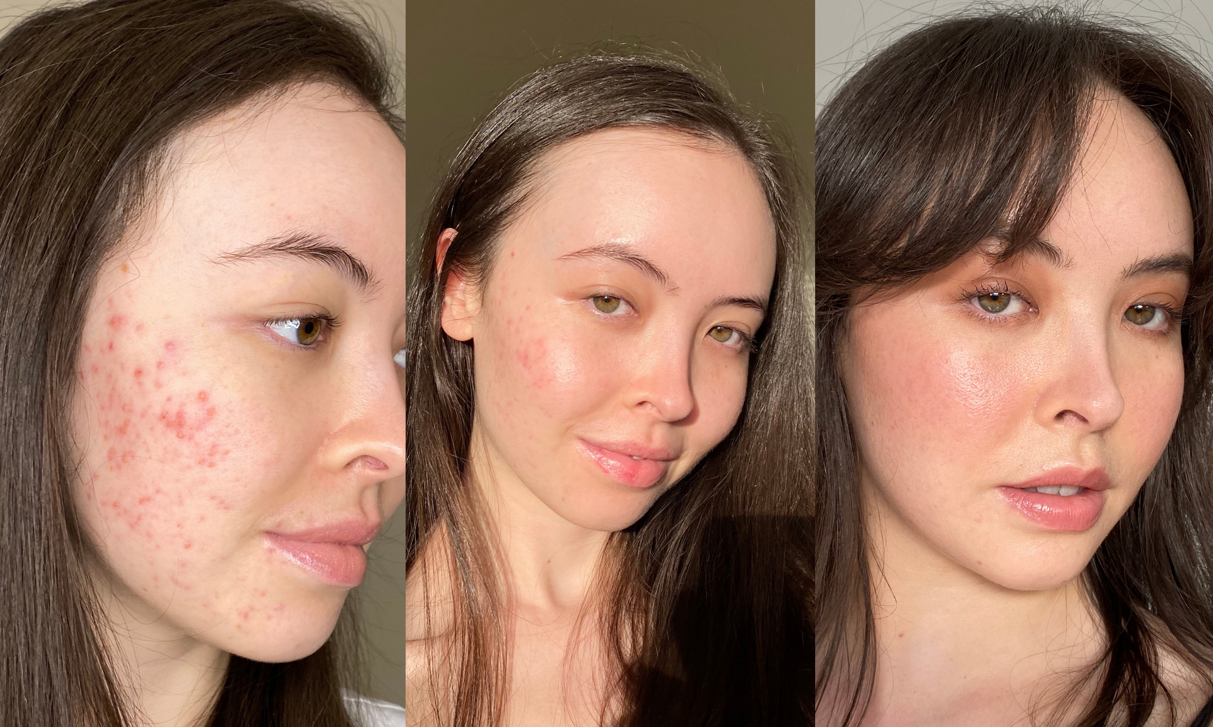 Perfectly Imperfect Skin: A Journey of Acne and Self Love By @sunshineeskin
